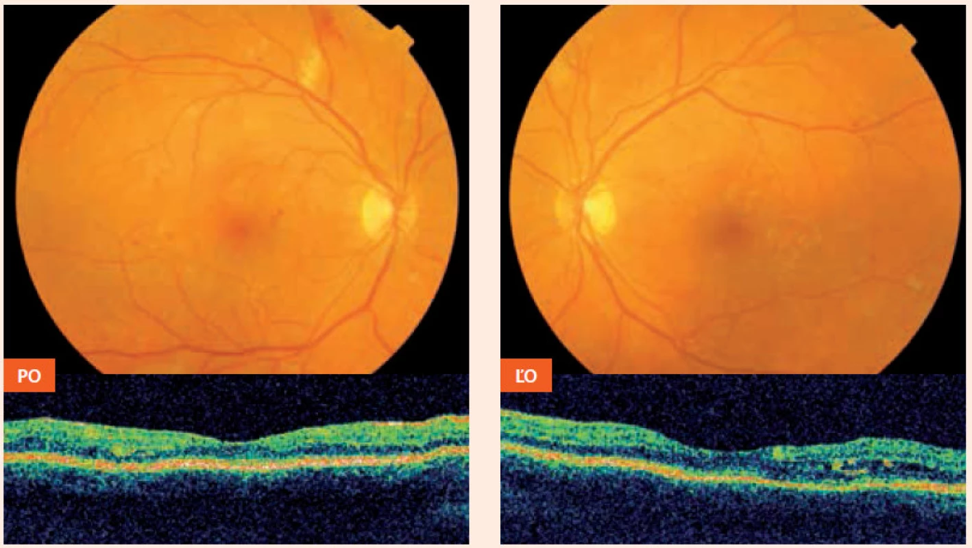 Nález pri prvom vyšetrení – 29. 4. 2011,16 mesiacov pred počatím (incipientná proliferatívna DR s edémom makuly vľavo) PO – pravé oko ĽO – ľavé oko
