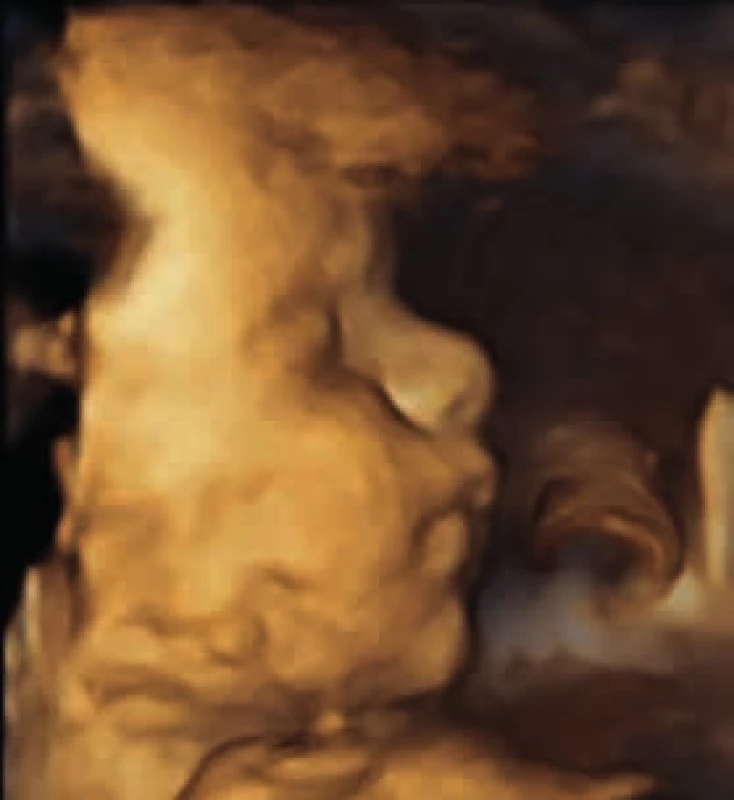 3-D ultrasonografické zobrazenie profilu tváre v 28.&lt;sup&gt;+6&lt;/sup&gt; týždni tehotnosti