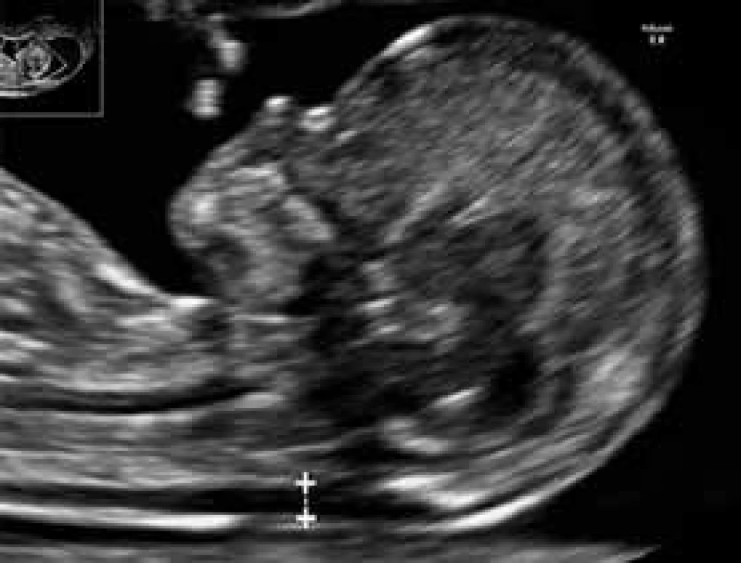 USG-meranie NT (nuchálnej translucencie) u plodu v 12.+4 týždni tehotnosti