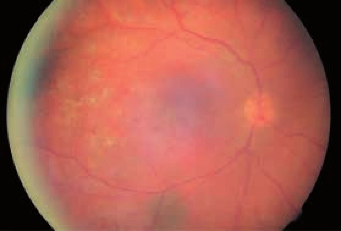 Pravé oko – po terapii anti-VEGF (3 aplikácie) a PRP (október 2012 a január 2013)