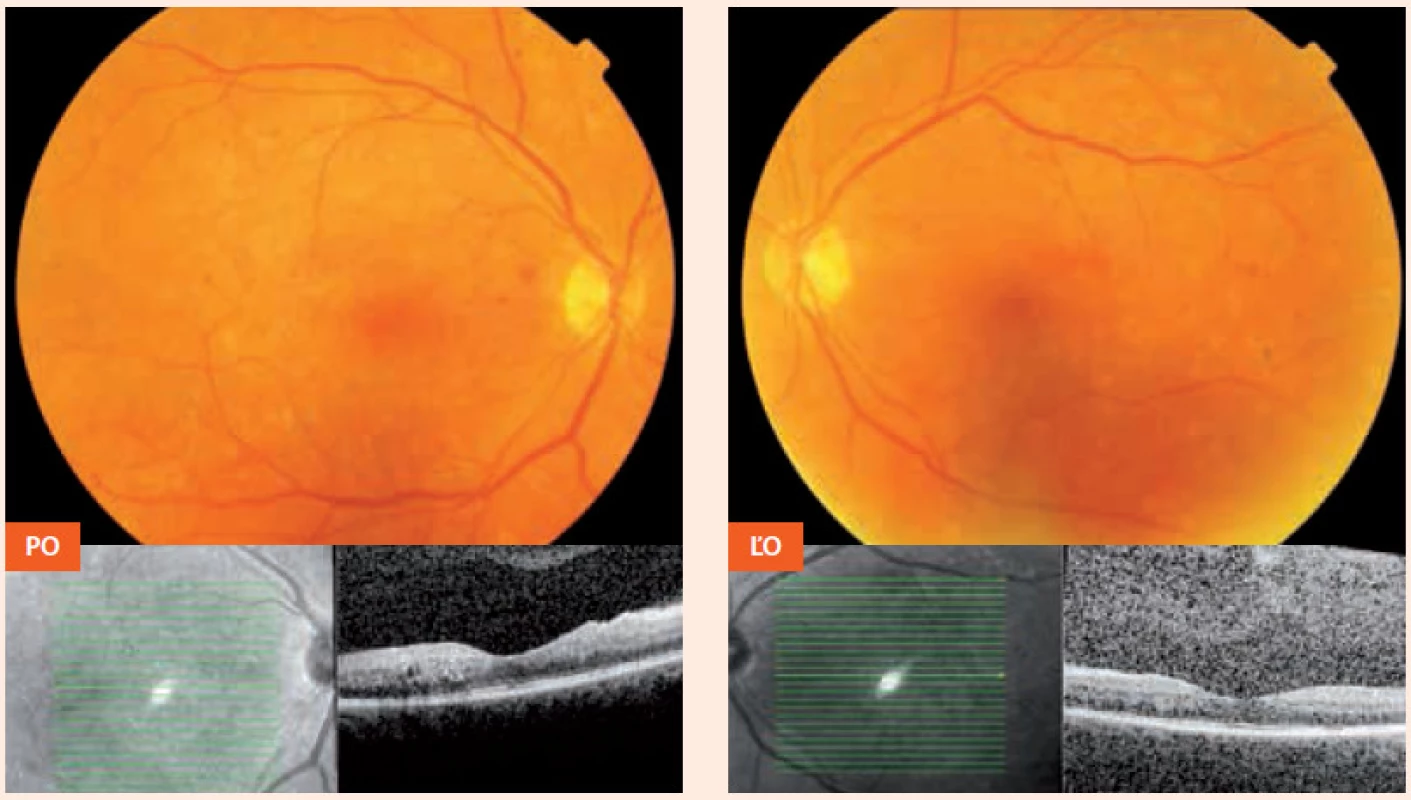 Nález 2 mesiace po pôrode (3. 6. 2013): makula obojstranne bez edému, DR v tzv. kľudovom štádiu PO – pravé oko ĽO – ľavé oko