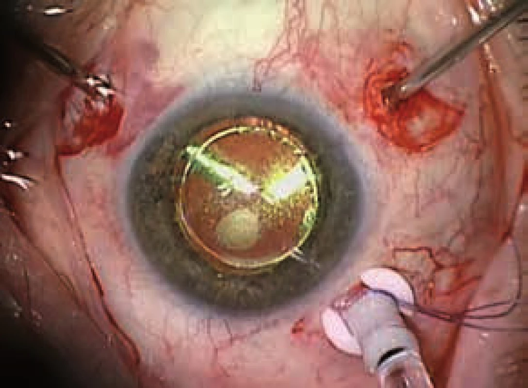 Pars plana vitrektómia – pohľad chirurga počas odsekávania sklovca