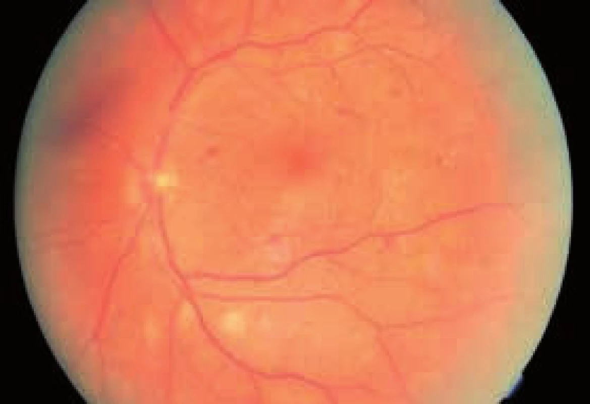 Obr. 2. Ľavé oko – po terapii anti-VEGF (3 aplikácie) a PRP (júl 2012 a október 2012)