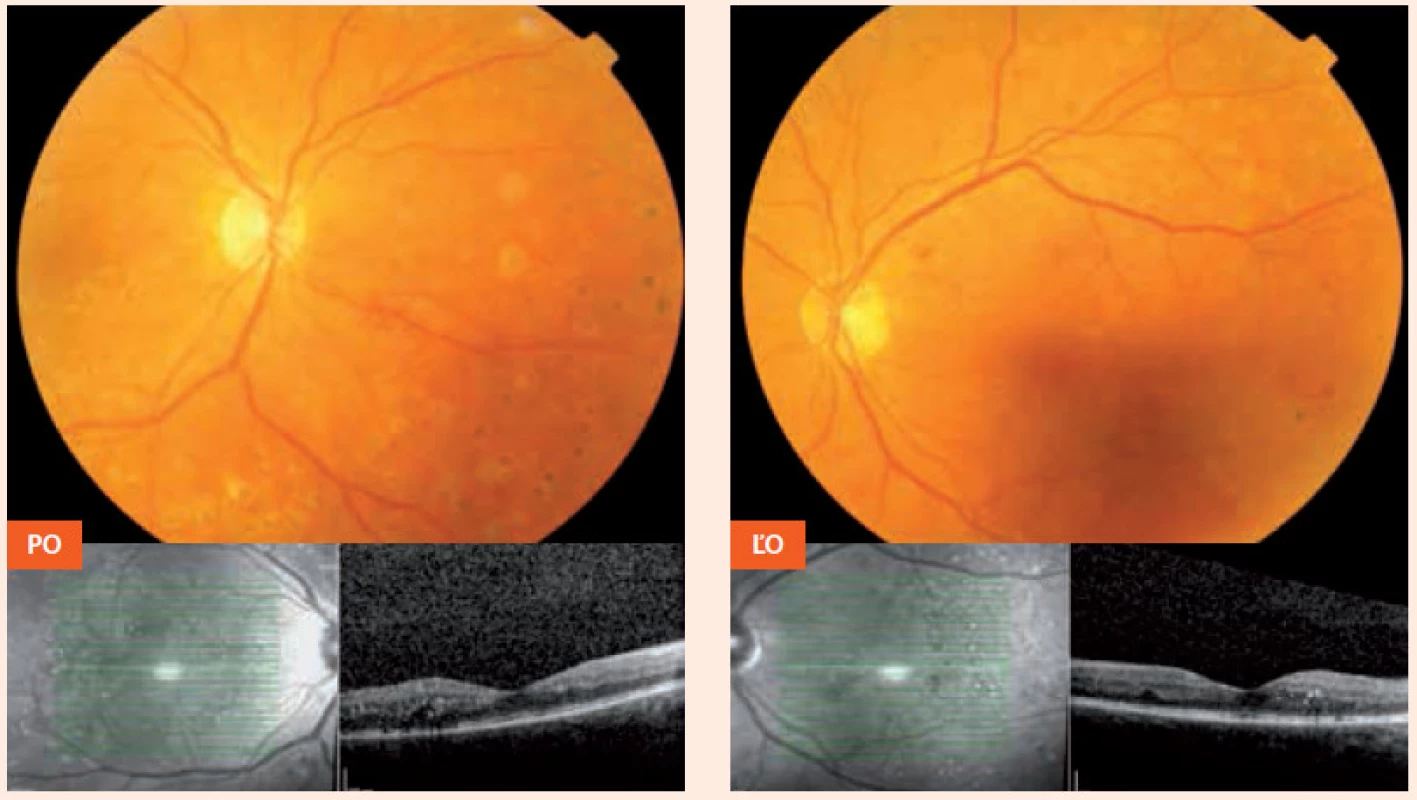 Nález približne 1 mesiac pred počatím (16. 7. 2012) – po ošetrení laserkoaguláciou PO – pravé oko ĽO – ľavé oko