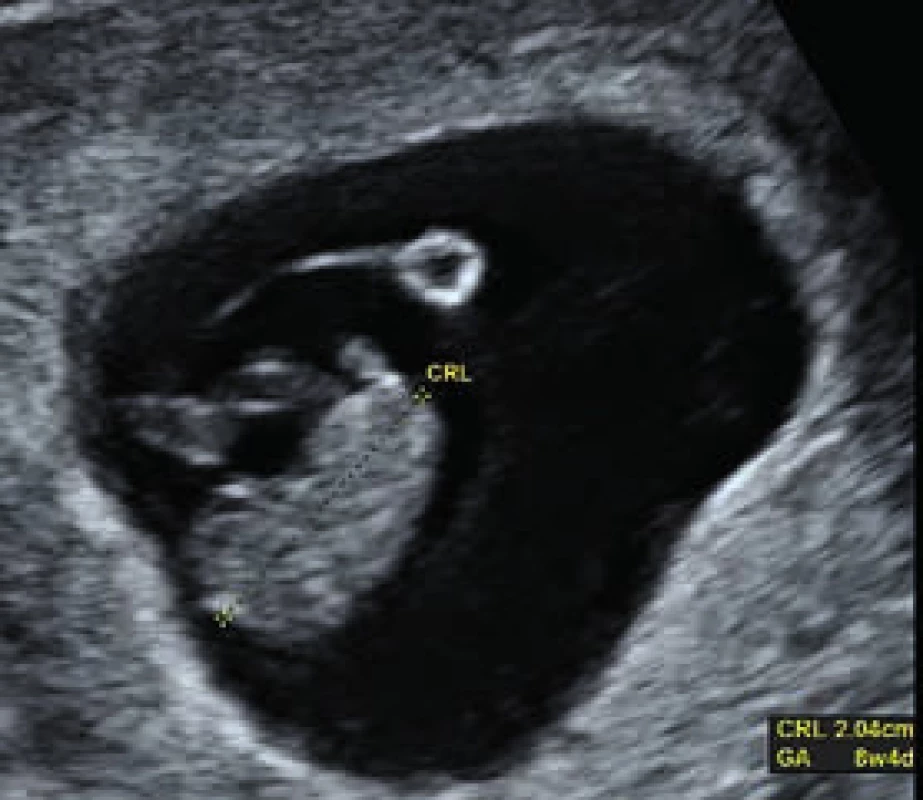Meranie vzdialenosti CRL (temeno-kostrč) v 8.+4 týždni tehotnosti