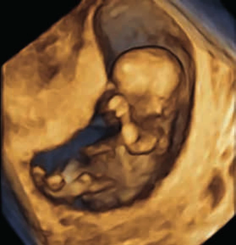 3-D ultrasonografické zobrazenie plodu v 12.&lt;sup&gt;+2&lt;/sup&gt; týždni tehotnosti