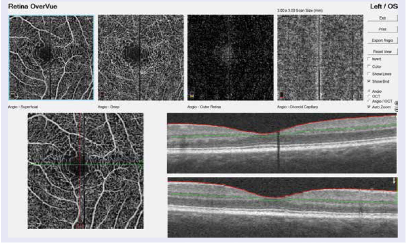 AngioOCT ľavého oka s NPDR: zobrazenie povrchového sietnicového plexu, hlbokého sietnicového plexu, vrstvy pigmentového epitelu sietnice a choriokapilaris
