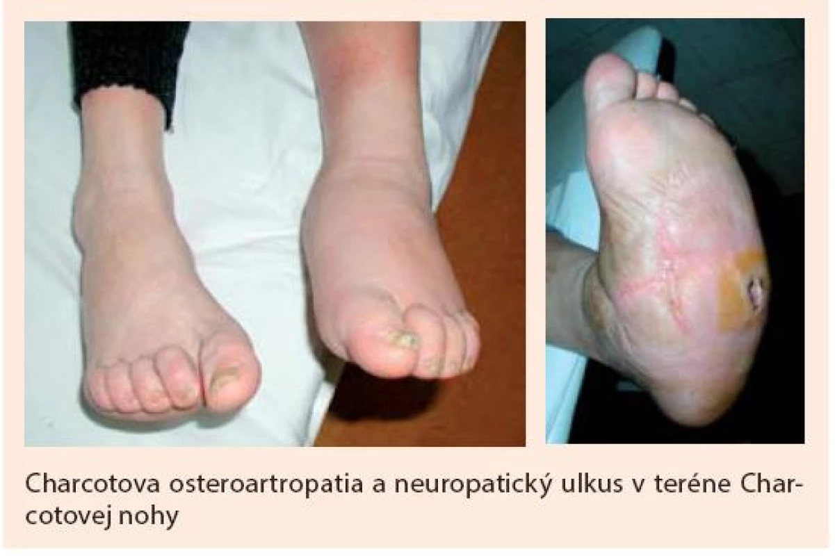 Charcotova noha (osteoartropatia)