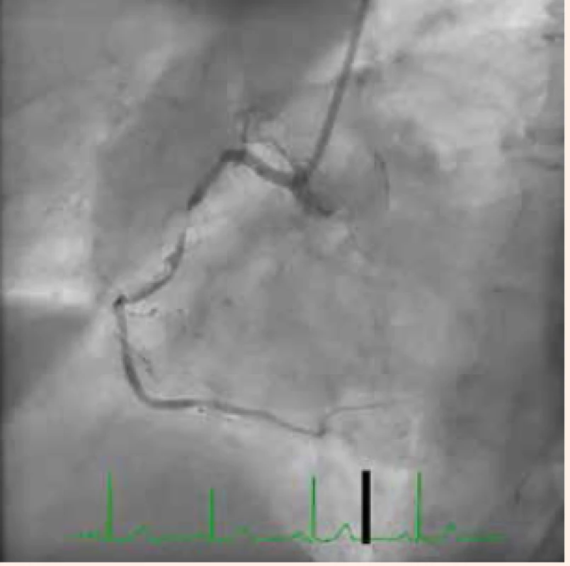 Pacientka so stabilnou anginou pektoris, kritická lézia pravej koronárnej artérie (PKA), prietok TIMI III. Foto archív autorky