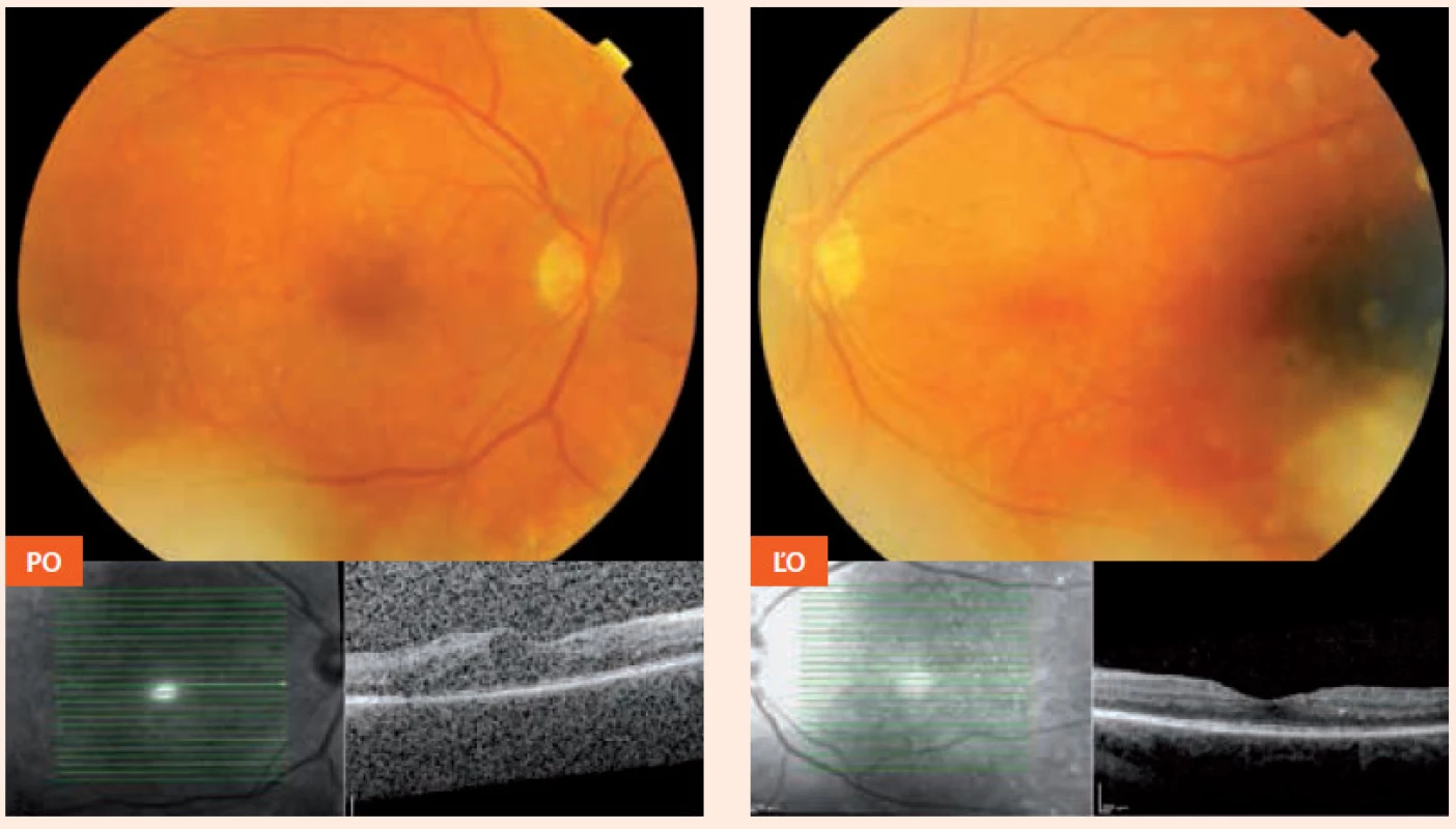 Nález 5 dní pred pôrodom 22. 3. 2013 (recidivujúci edém makuly vpravo, normálna makula vľavo)
PO – pravé oko ĽO – ľavé oko