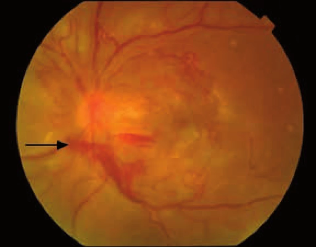 Proliferatívna diabetická retinopatia. Rozsiahla fibrovaskulárna proliferácia z terča zrakového nervu s početnými úponmi na okolitú sietnicu a s retrohyaloidným krvácaním (šípka).