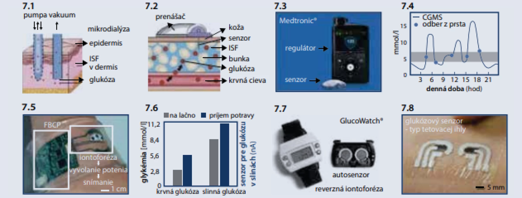 Monitorovanie glukózy v intersticiálnej tekutine [12]