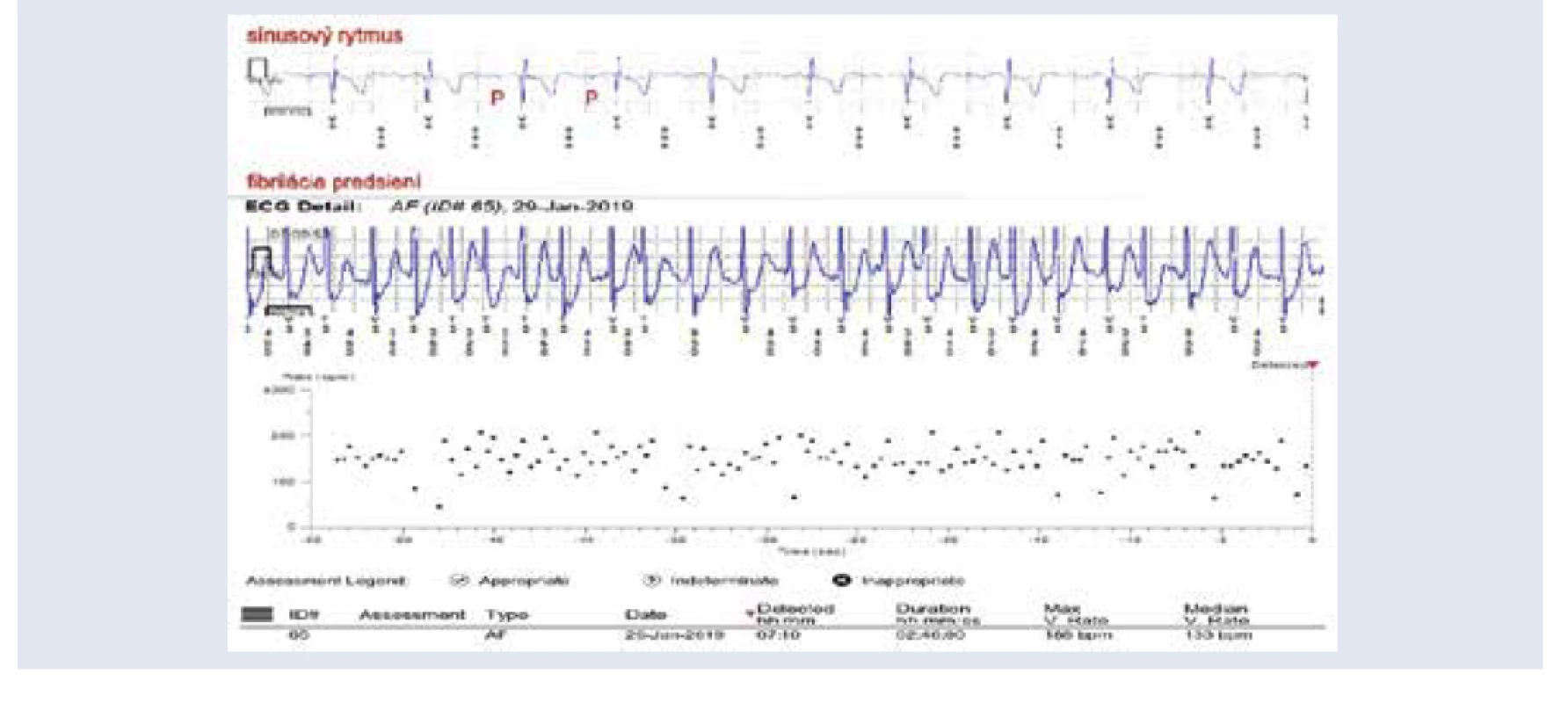 Záchyt paroxyzmu fibrilácie predsiení prostredníctvom implantovateľného slučkového záznamníka u
pacienta po prekonaní ischemickej CMP. Výpis z diaľkového monitoringu. V hornej časti obrázka EKG
so sínusovým rytmom, pod ním EKG so záchytom fibrilácie predsiení v trvaní 2 hodiny a 46 minút.
V dolnej časti obrázka plotový diagram vyjadrujúci nepravidelnú a rýchlu komorovú aktivitu pri
fibrilácii predsiení. <br>
Z archívu autorky