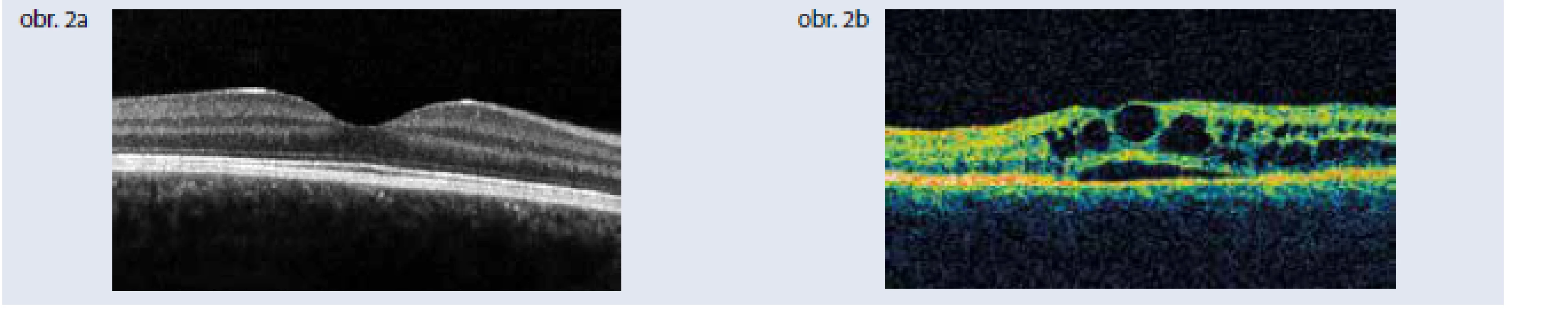 Optická koherentná tomografia. Obr. 2a | Optická koherentná tomografia normálnej makuly
Obr. 2b | Optická koherentná tomografia diabetického cystoidného edému makuly. Archív autorky