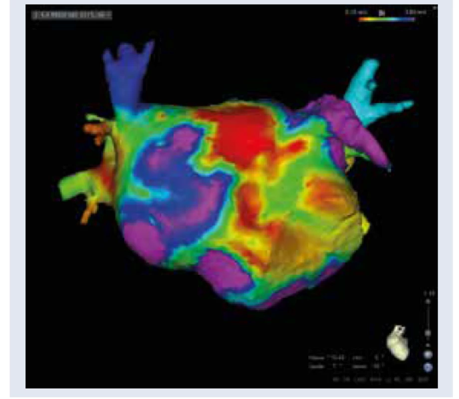 Štrukturálna remodelácia ĽP u pacienta
s DM (pohľad spredu). Elektroanatomická
mapa ĽP (vysoko denzitné mapovanie, systém
CARTO 3) s vizualizáciou rozsiahlych zón s minimálnou
amplitúdou lokálnych elektrogramov
ako analógiou fibrotickej prestavby ĽP.
Spektrum červenej, žltej a zelenej a modrej
farby zobrazuje zóny s minimálnym potenciálom
(0,1-0,4 mV). Fialová farba reprezentuje
normálnu výšku potenciálov (nad 0,5 V).
Pacient s dlhodobo perzistujúcou FP a DM.<br>
Archív autora