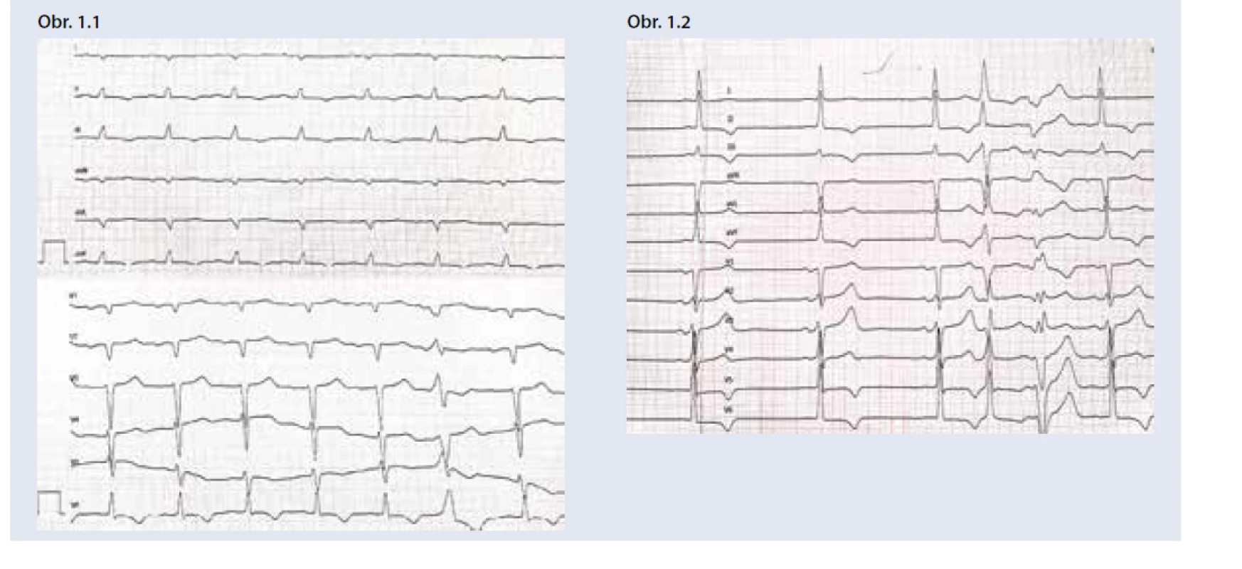 Príklady EKG pacientov so špecifickými príčinami hypertrofie ĽK: a) EKG pacienta s AL amyloidózou
srdca – nízka voltáž QRS v štandardných zvodoch, obraz pseudonekrózy Q V1-2, AV-blokáda 1. stupňa
(PQ 220 ms) b) EKG pacienta s Fabryho chorobou – vysoká voltáž QRS, repolarizačné zmeny
v inferolaterálnych zvodoch, hraničné PQ (120 ms). <br>
Archív autora