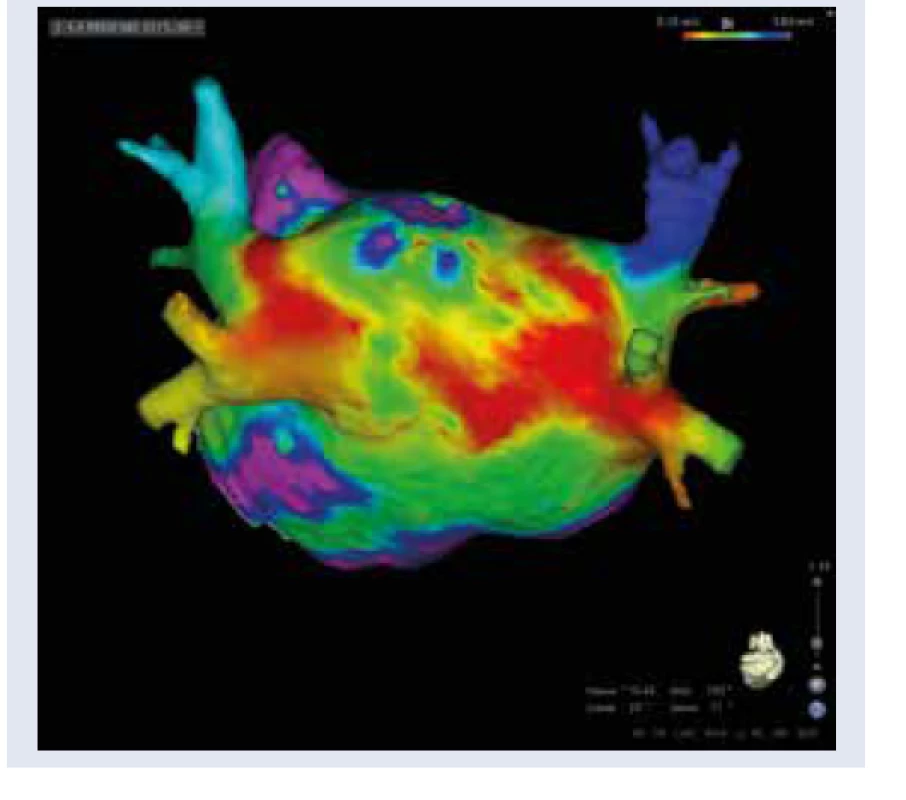 Štrukturálna remodelácia ĽP u pacienta
s DM (pohľad zozadu). Elektroanatomická
mapa ĽP (vysoko denzitné mapovanie, systém
CARTO 3) s vizualizáciou rozsiahlych zón s minimálnou
amplitúdou lokálnych elektrogramov
ako analógiou fibrotickej prestavby ĽP.
Spektrum červenej, žltej, zelenej a modrej
farby zobrazuje zóny s minimálnym potenciálom
(0,1-0,4 mV). Fialová farba reprezentuje
normálnu výšku potenciálov (nad 0,5 mV).
Pacient s dlhodobo perzistujúcou FP a DM.<br>
Archív autora